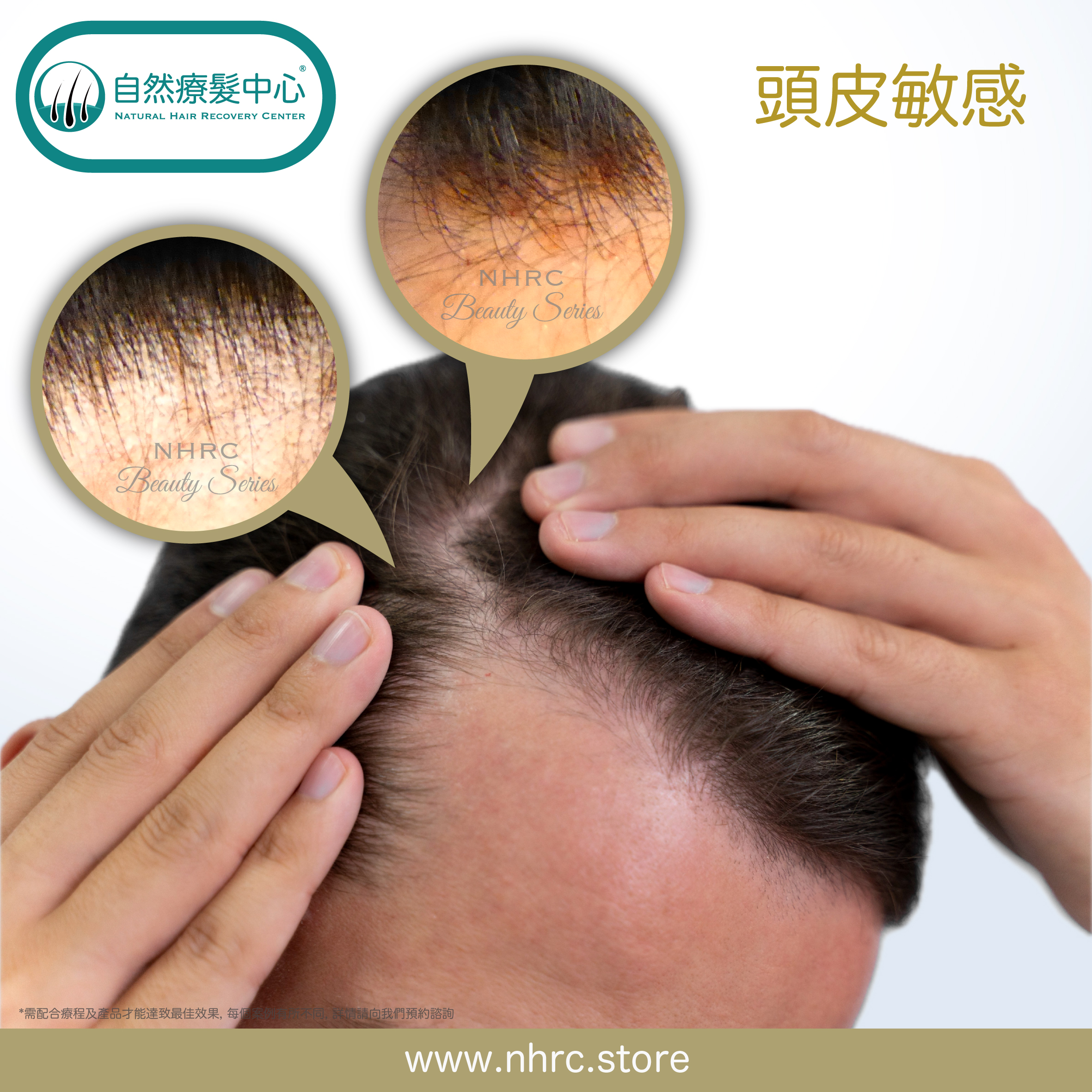 頭皮敏感 Sensitive Scalp