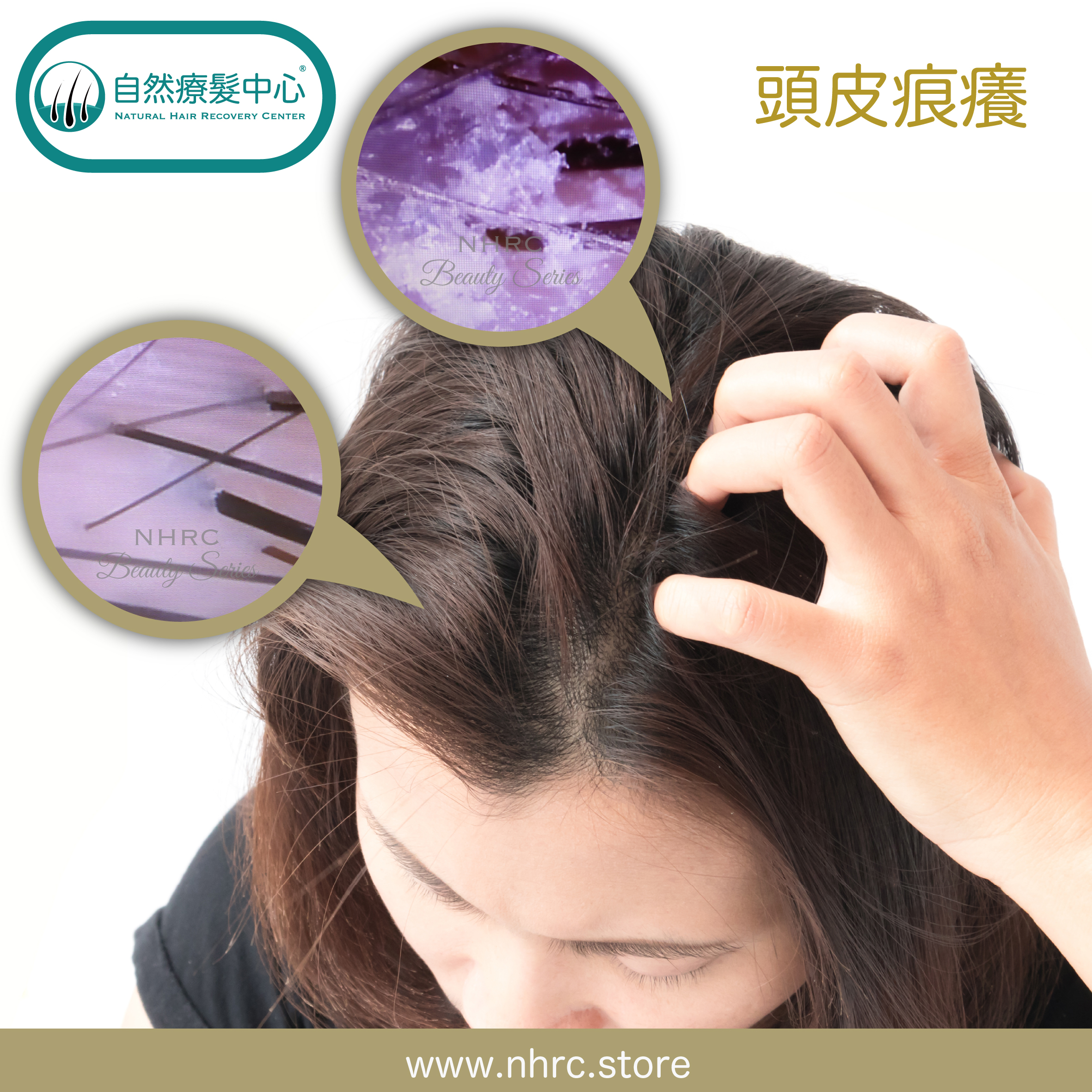 頭皮痕癢 Itchy Scalp