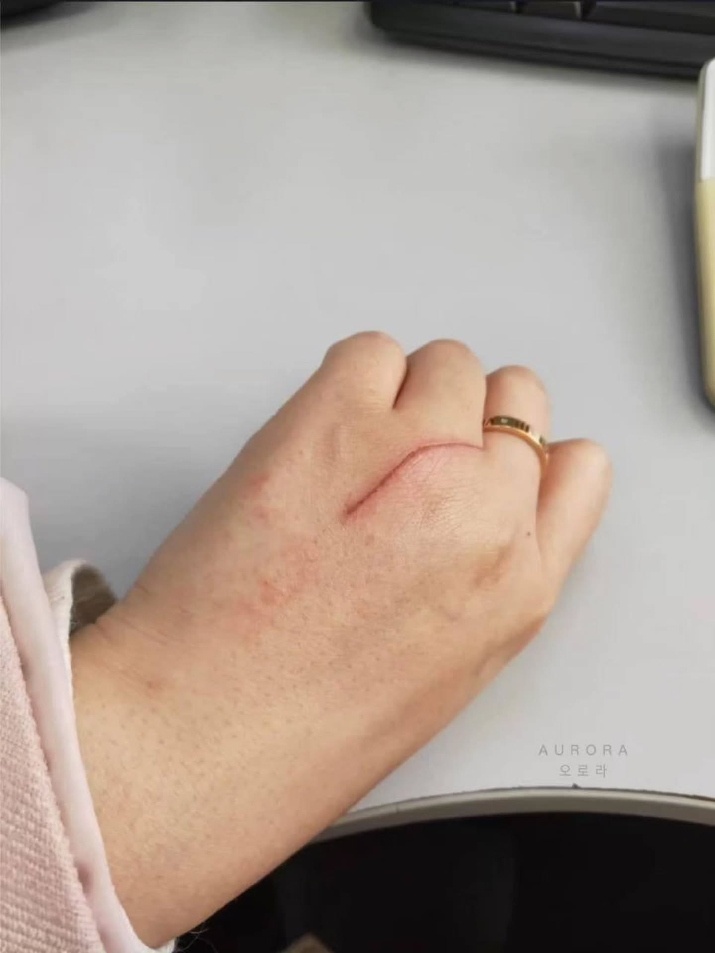 🇯🇵【日本小林制药祛疤膏】15G