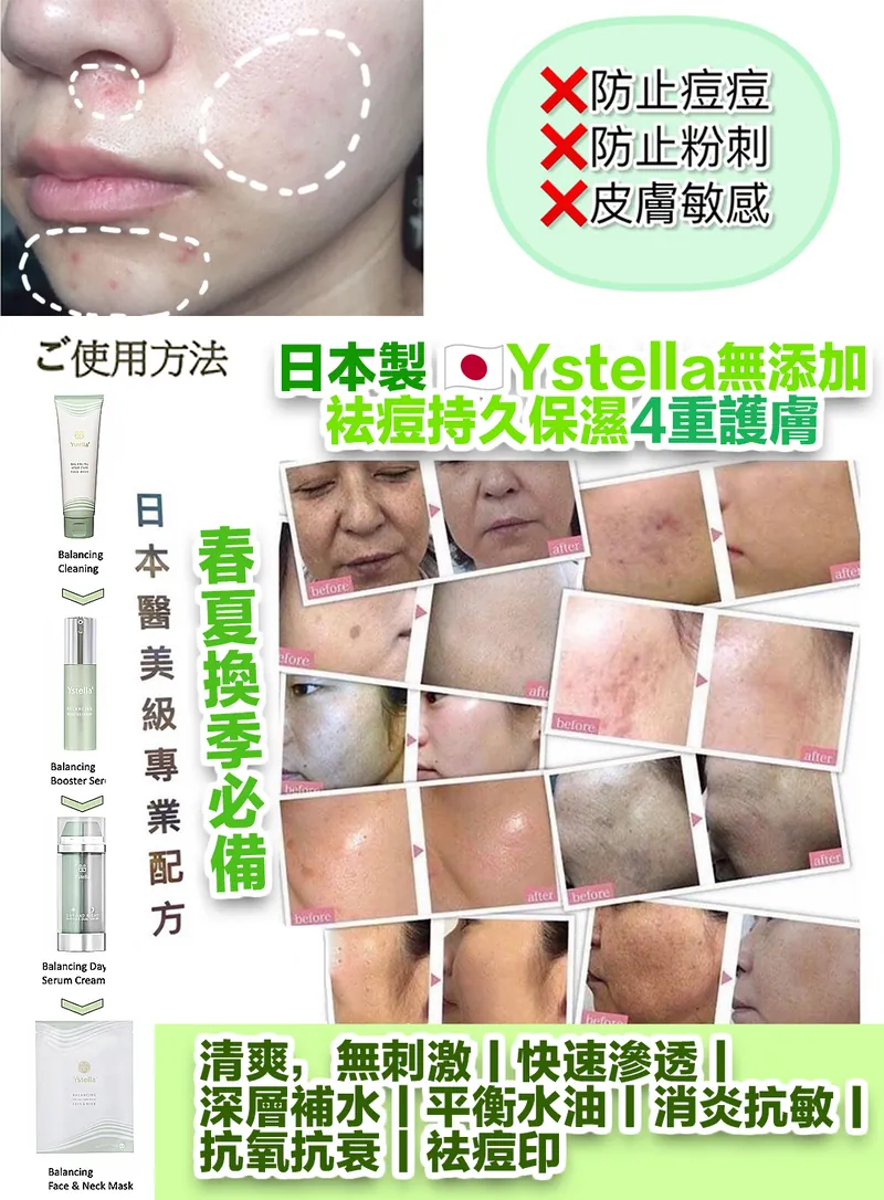 雙11大優惠💯日本製🇯🇵Ystella袪痘泡沬潔面霜120g❤️買一送一❤️再送10支NMN精華  
