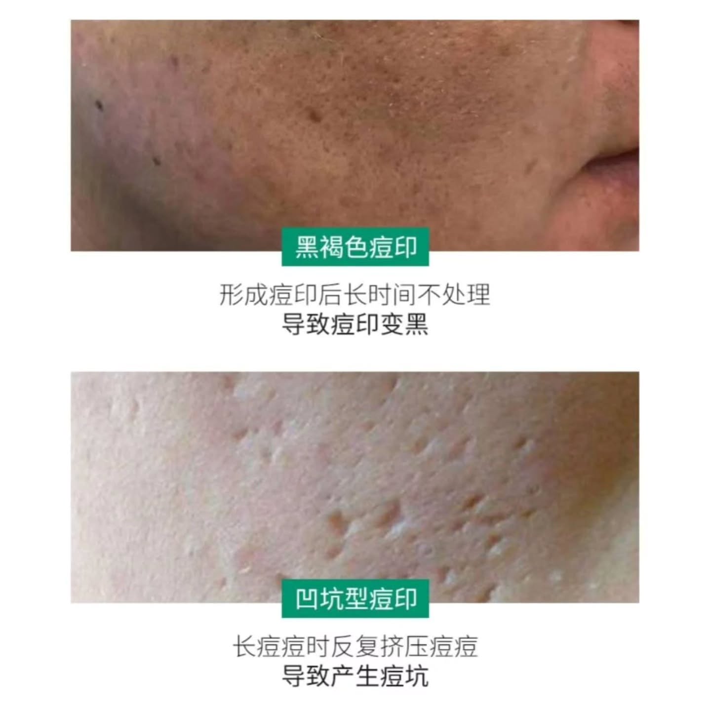 🇯🇵【 日本小林祛痘印淡化黑色素 】10G