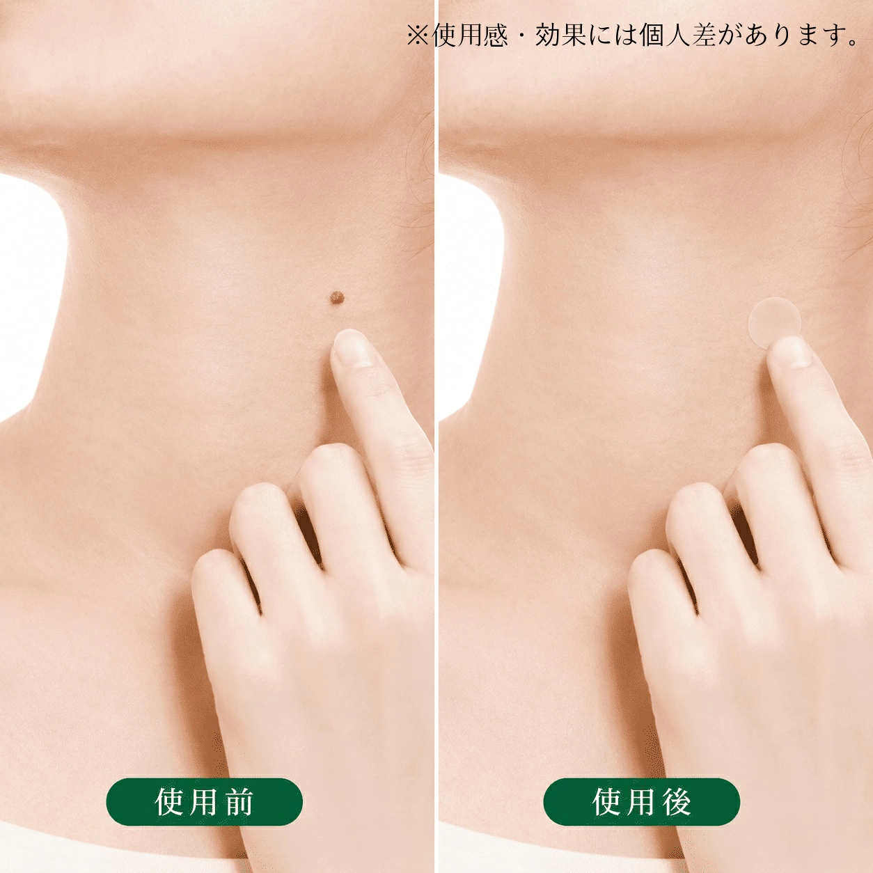 日本直送 Liberta Tsubuporon 角質粒 脂肪粒 修護隱形貼 (36枚入) 